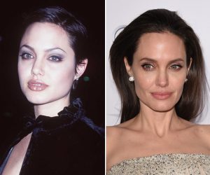 Angelina Jolie antes e depois bichectomia