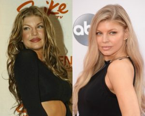 Cantora Fergie antes e depois Bichectomia