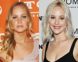 Atriz Jennifer Lawrence antes e depois Bichectomia