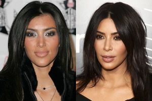 Kim Kardashian antes e depois Bichectomia
