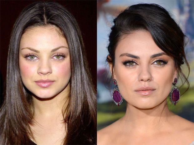 Atriz Mila Kunis antes e depois Bichectomia