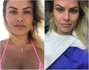 Natalia Casassola antes e depois Bichectomia