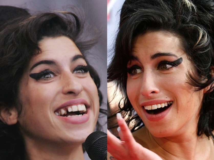 Cantora Amy Winehouse antes e depois Implante