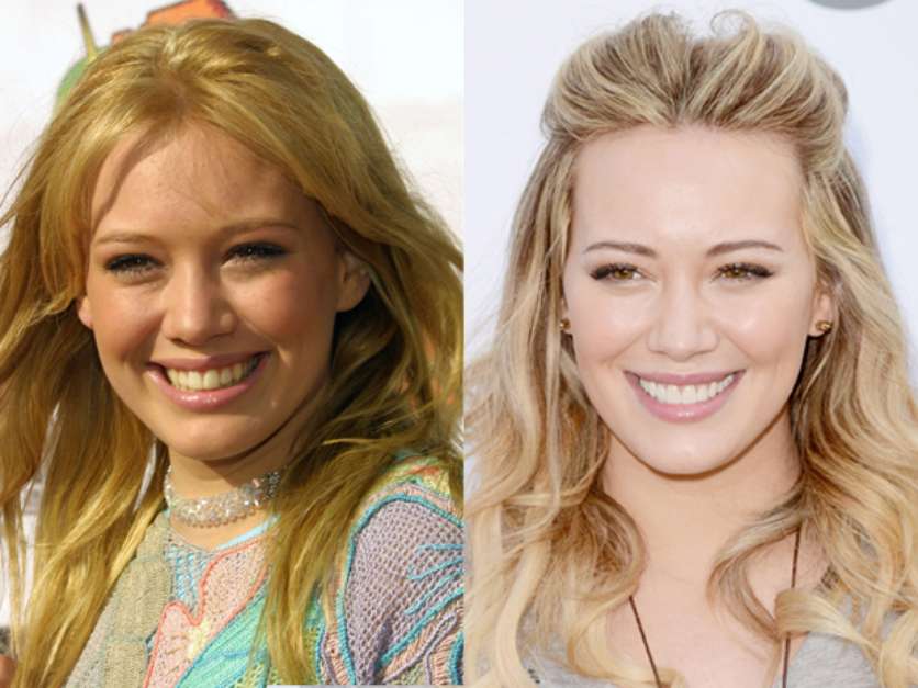 Atriz Hilary Duff antes e depois Implante