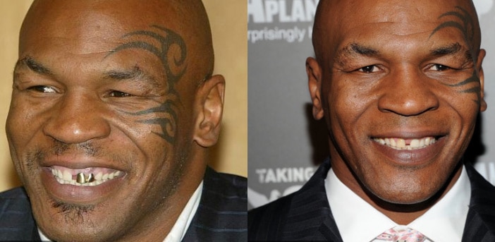 Boxeador Mike Tyson antes e depois Implante