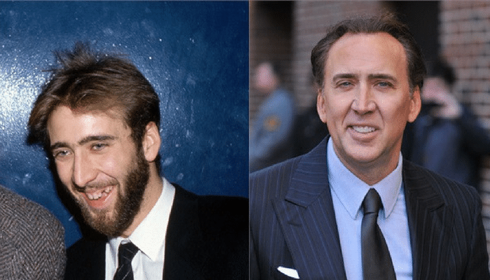 Ator Nicolas Cage antes e depois Implante