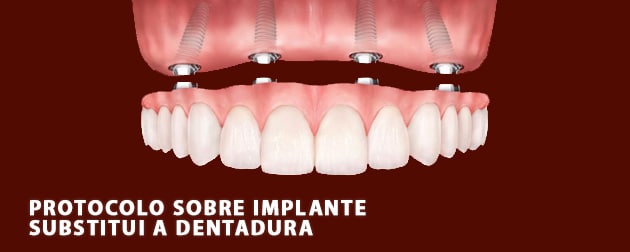 O protocolo sobre implante é o melhor substituto da dentadura