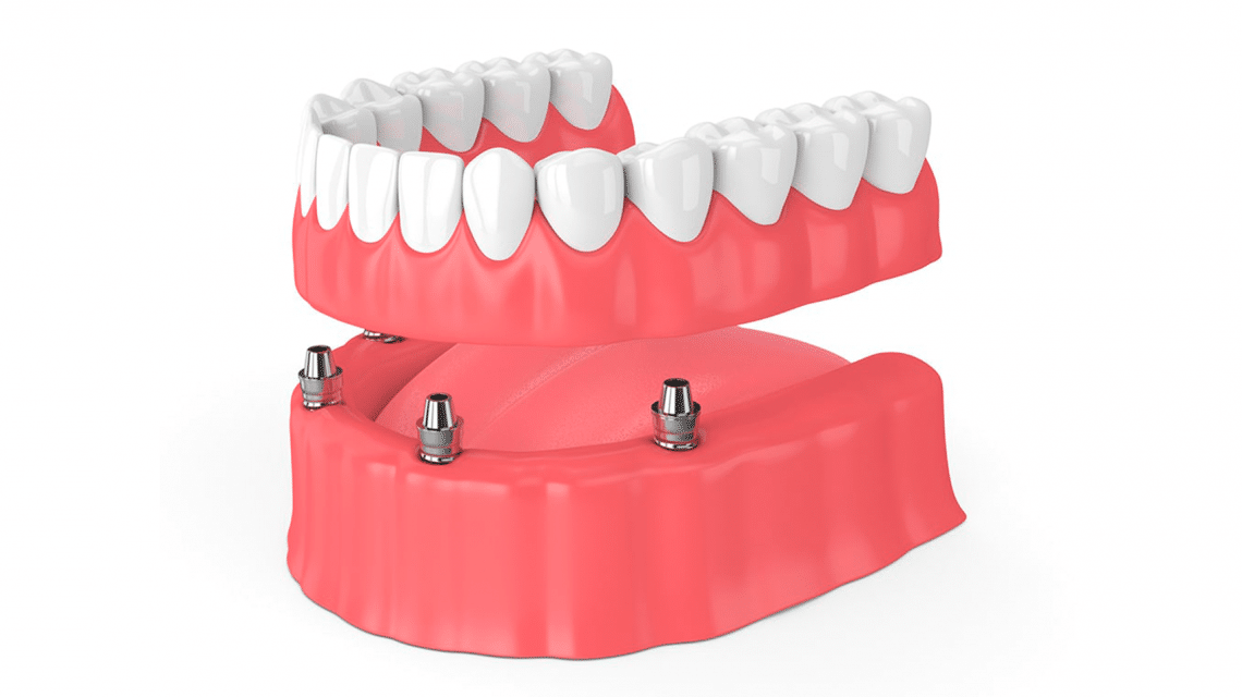 Implante com carga imediata substitui poucos ou todos os dentes perdidos