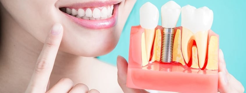 implante dentário mitos