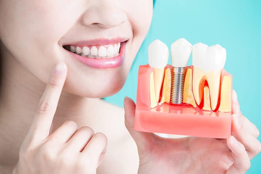 implante dentário mitos
