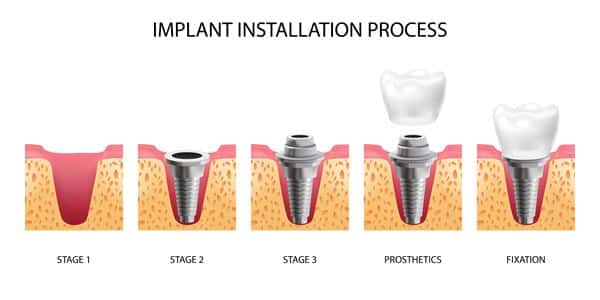 etapas do implante dentário