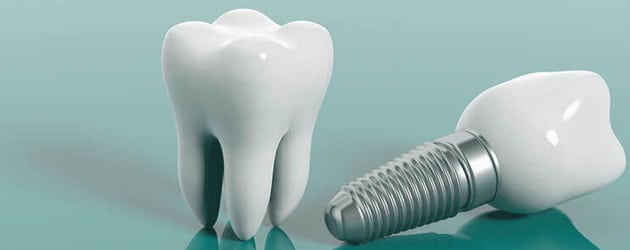 Implante dental é feito com titânio que não causa rejeição