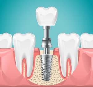 Ilustração de um implante dentário após extração