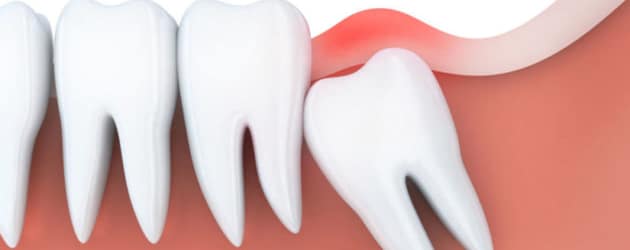 Dente siso pode nascer torto e prejudicar outros dentes