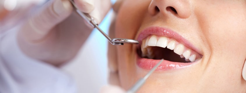 Manutenção de Implantes Dentários Agende a sua avaliação no CCO