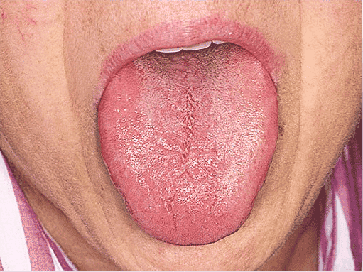 Fissuras na língua de pessoas idosas pode ser sintoma de baixa salivação
