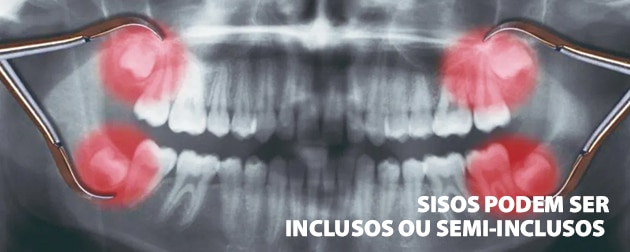 Extração do siso: tudo o que você precisa saber! - CCO