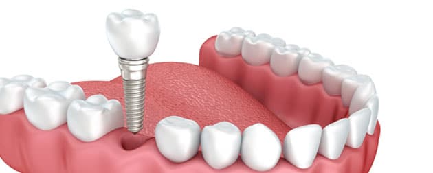 Implante dentário é feito com anestesia e não dói 