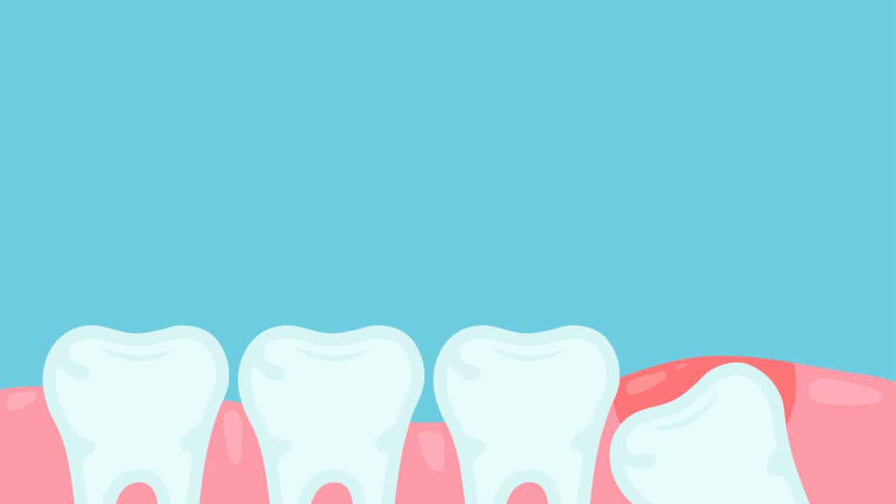 Desenho estilizado de dentes em uma gengiva saudável, com destaque para o dente do siso em uma posição anormal, representando desconforto ou inflamação.