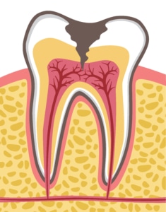 Ilustração detalhada de um corte transversal de um dente molar afetado por cárie profunda, mostrando danos à dentina e polpa. A imagem serve como um alerta visual sobre os danos causados pela cárie e a importância de cuidados preventivos para nunca mais ter cárie.