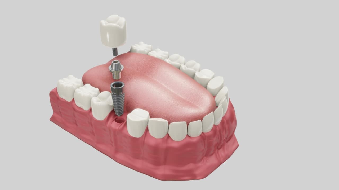 representação de implante dentário substituindo dente de trás perdido