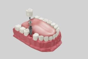 representação de implante dentário substituindo dente de trás perdido
