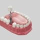 representação de implante dentário substituindo dente de trás perdido