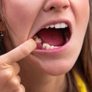 mulher-jovem-sem-dente-no-maxilar-inferior-dente-faltando